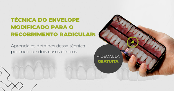 TÉCNICA DO ENVELOPE MODIFICADO PARA O RECOBRIMENTO RADICULAR